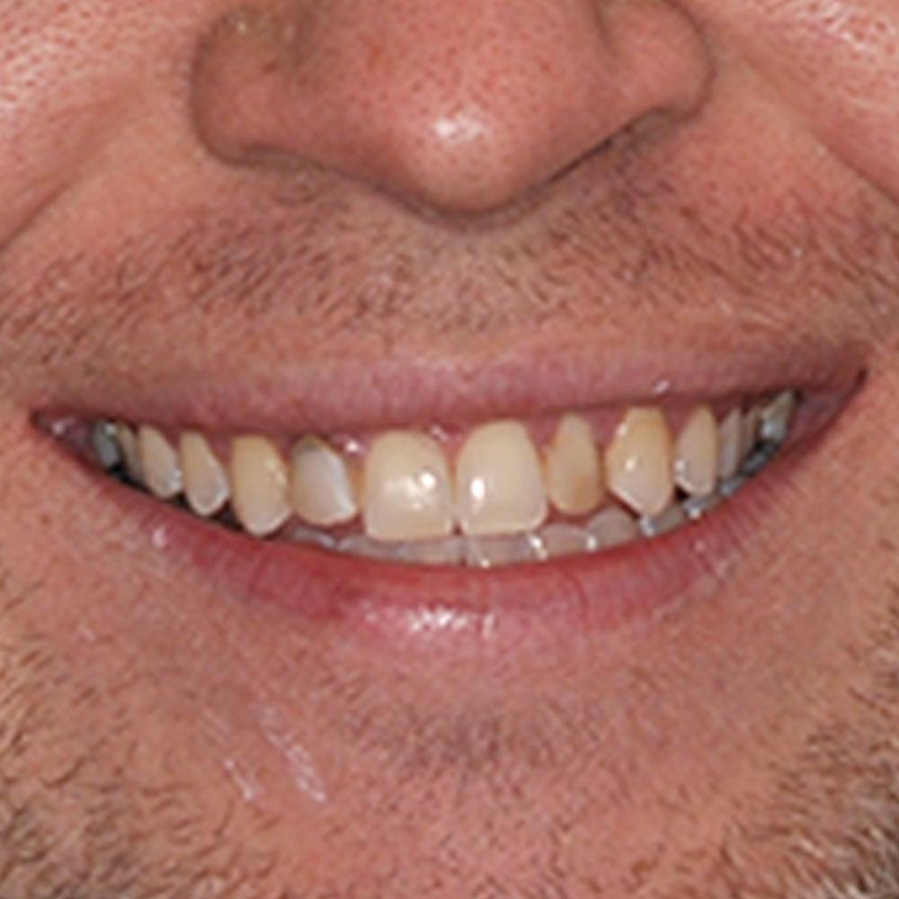 before Repairing Two Teeth and Improving the Whole Smile