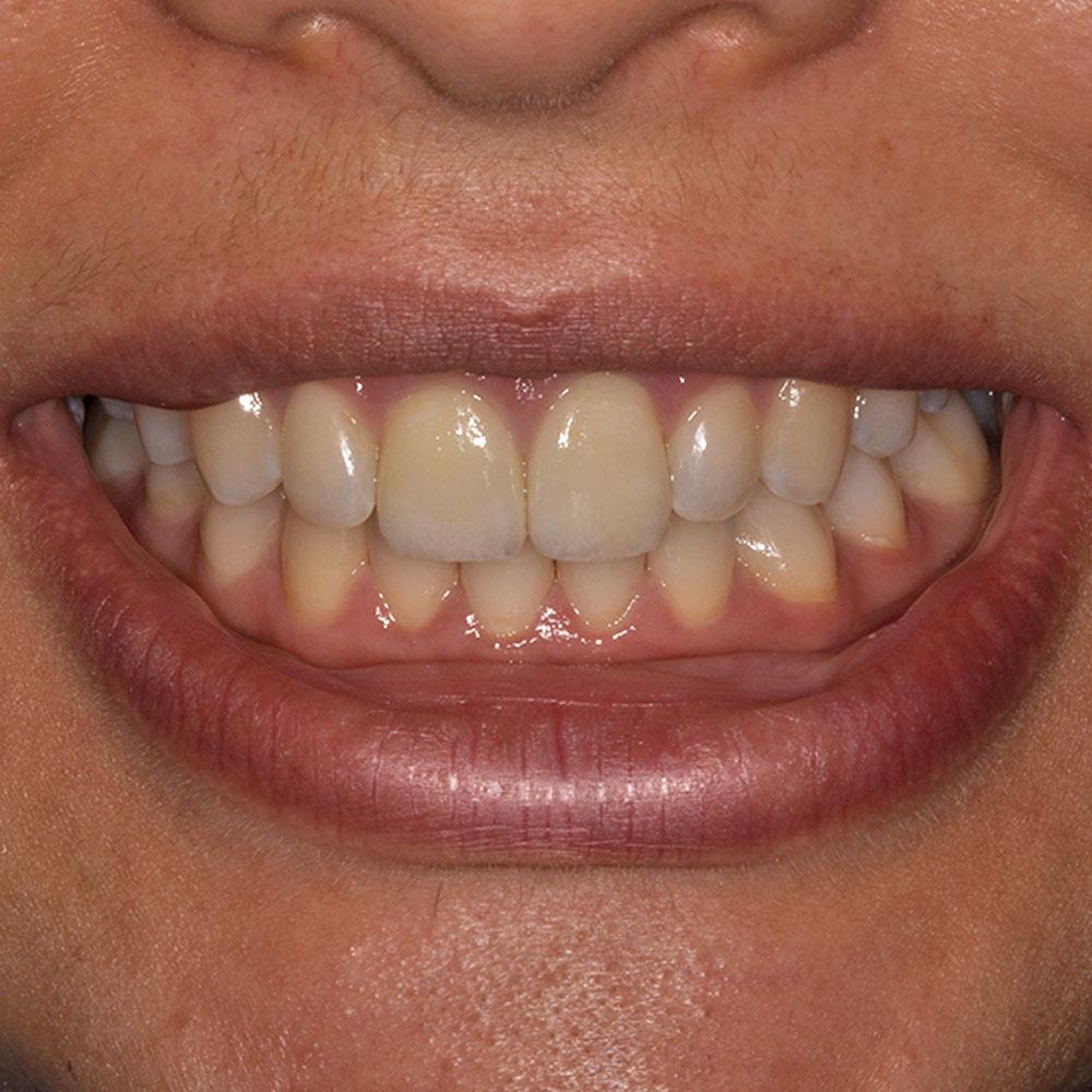 After Adding Veneers to the Front Two Teeth
