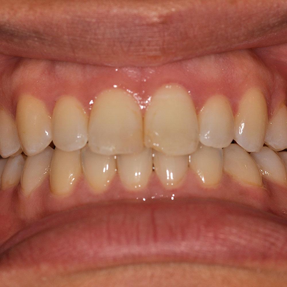 Before Adding Veneers to the Front Two Teeth