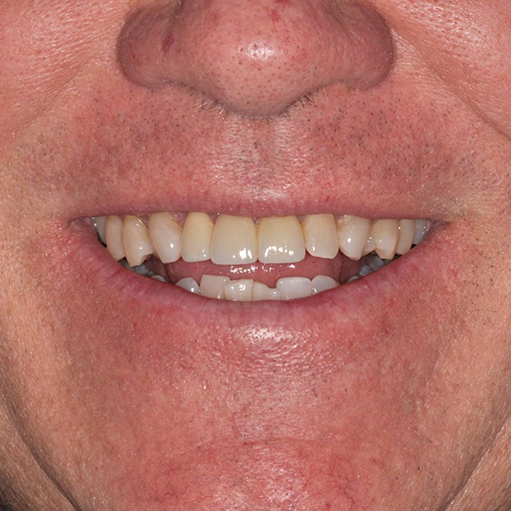 after Repairing Teeth That Are Stained with Receding Gums