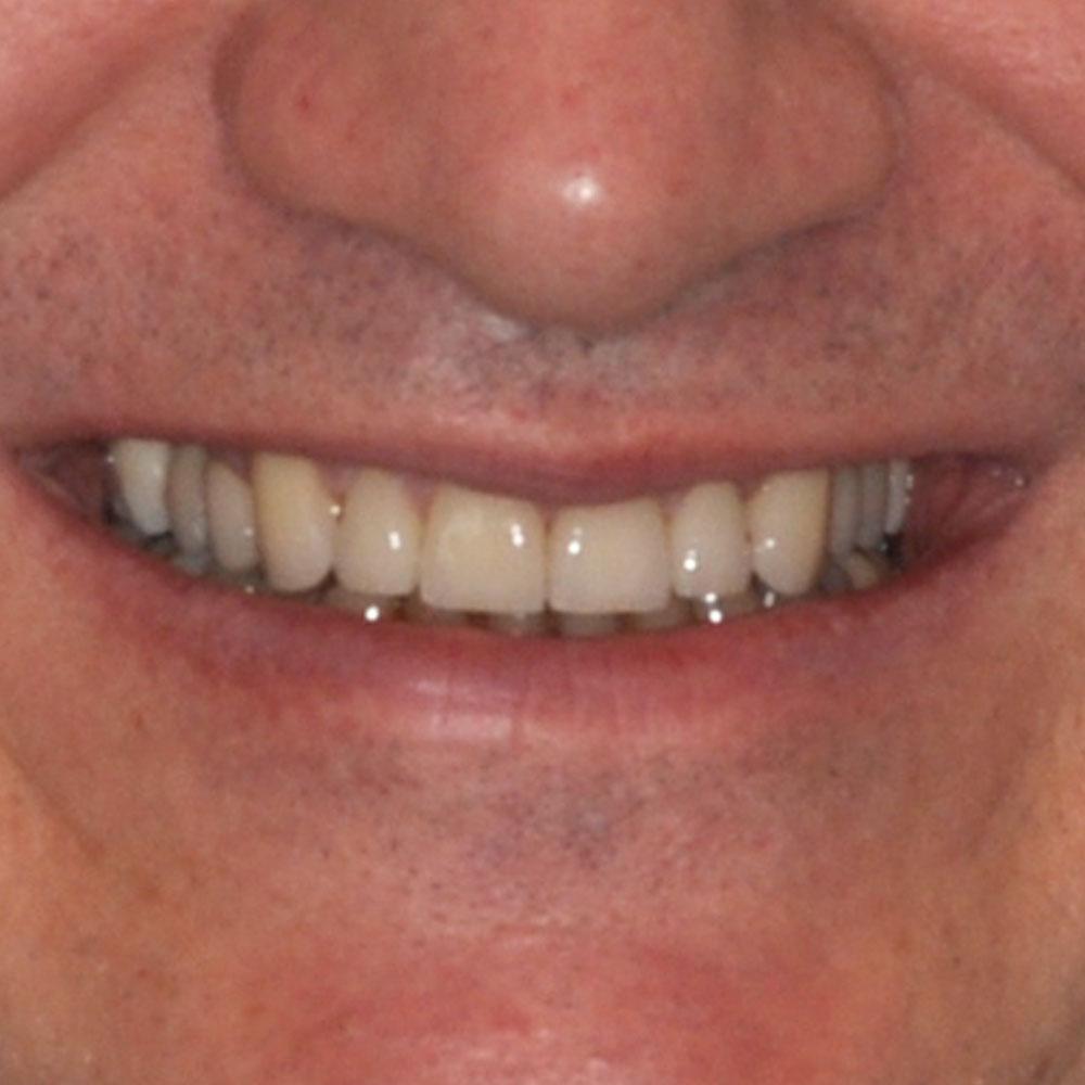 After Using Implants to Repair a Smile