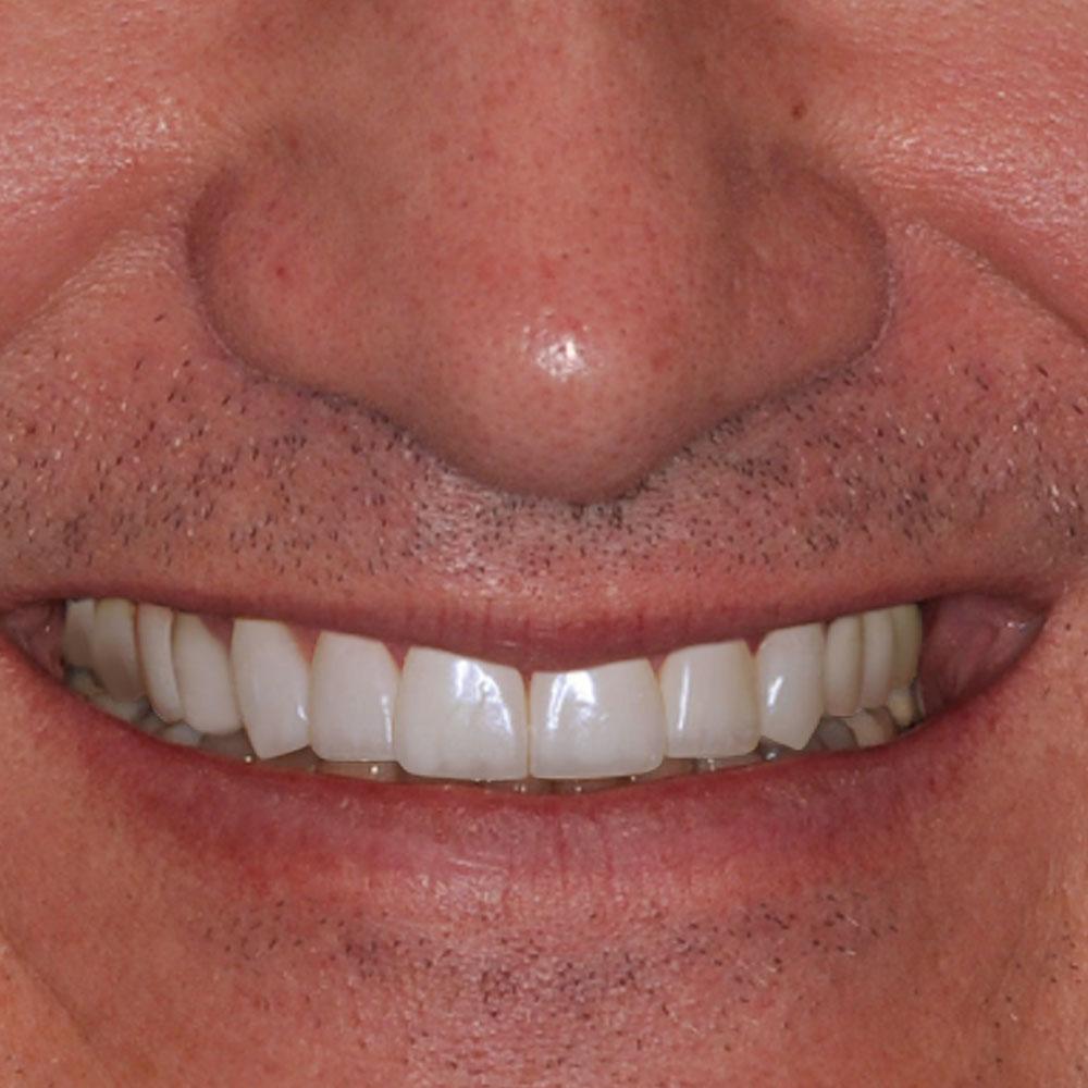 A simulation of using implants to repair a smile