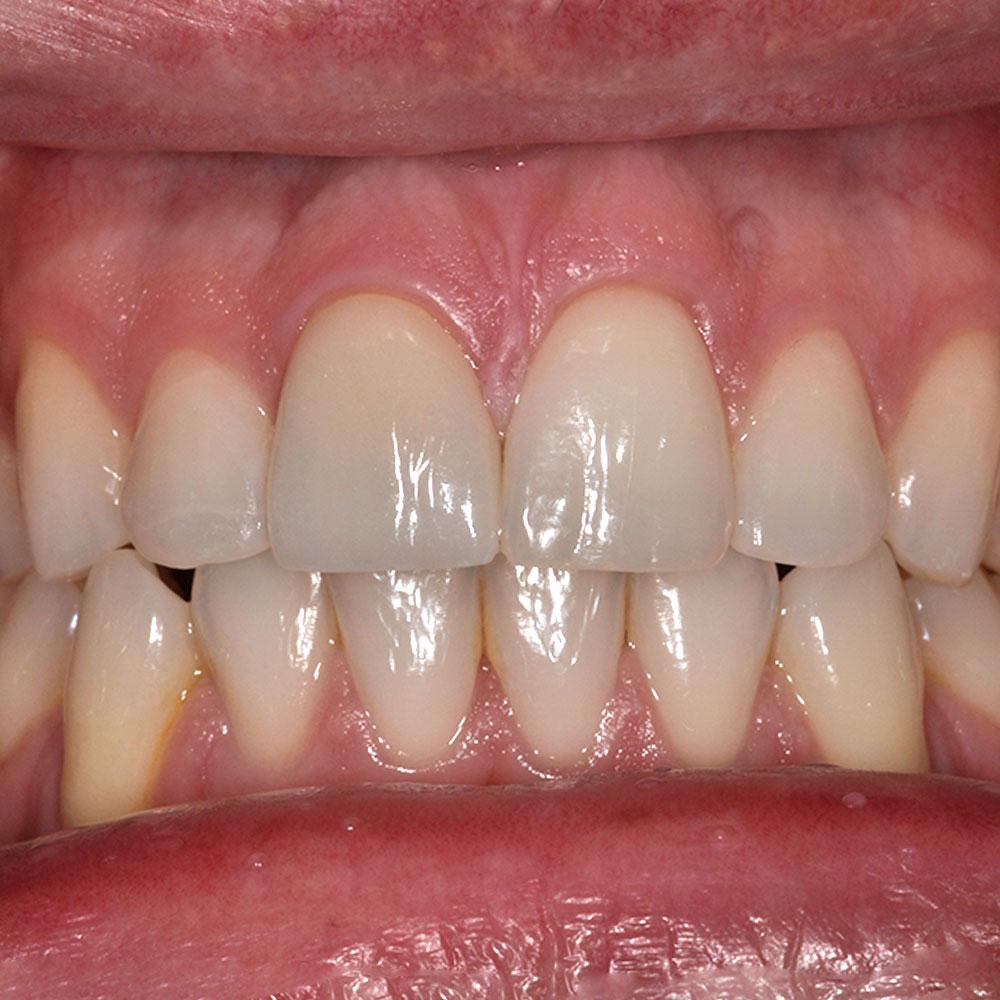 After Repairing a Damaged Tooth with Excellent Results