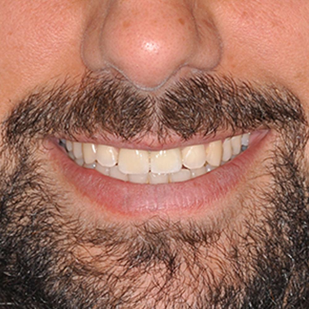 After Veneers and Implants Can Improve the Look and Health of a Smile