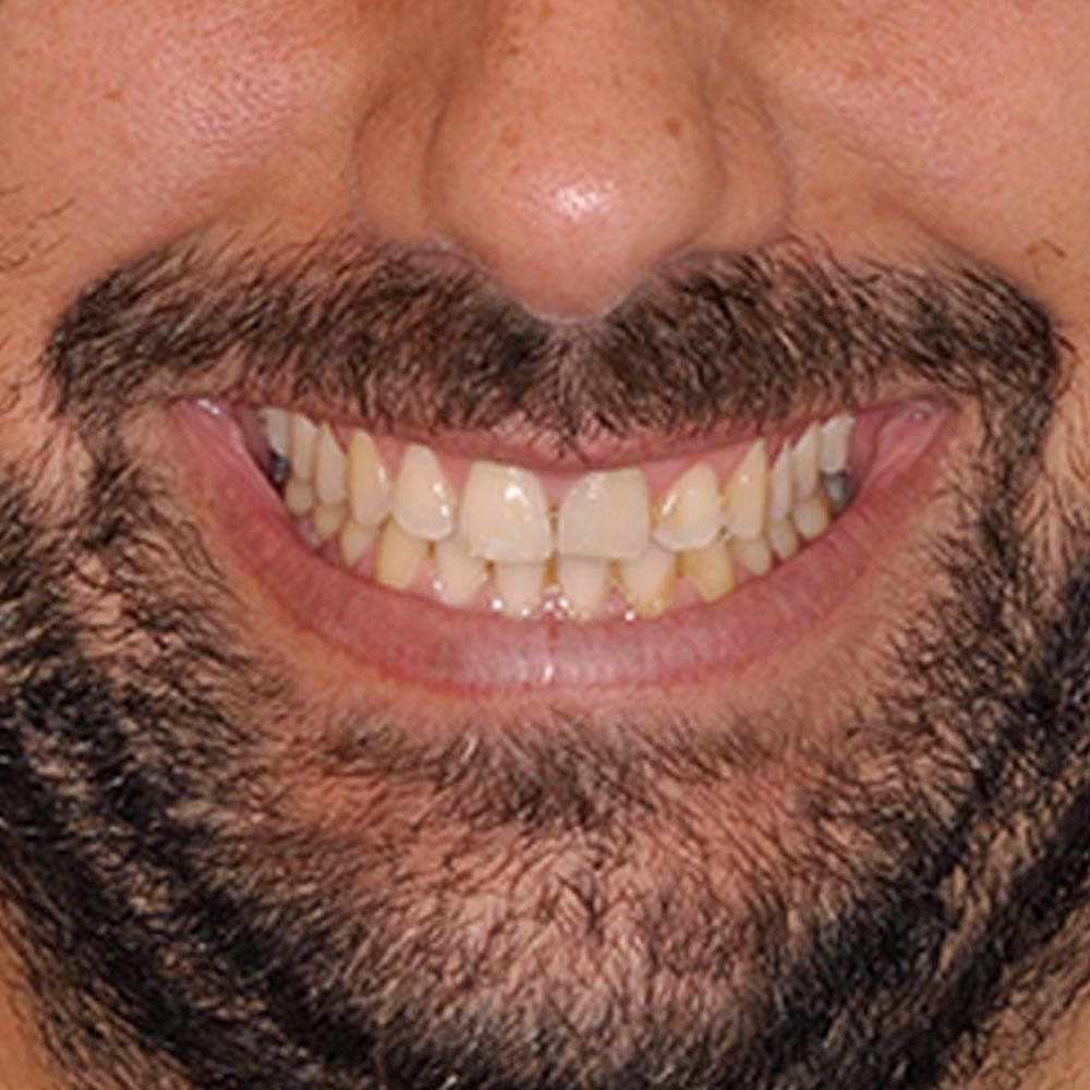 Before Veneers and Implants Can Improve the Look and Health of a Smile