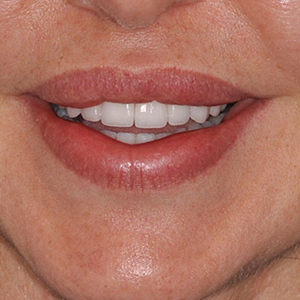 After Using Veneers to Restore the Shape and Shine of this Smile