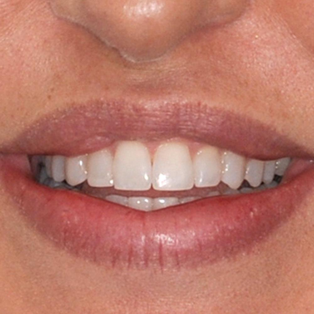 Before Using Veneers to Restore the Shape and Shine of this Smile