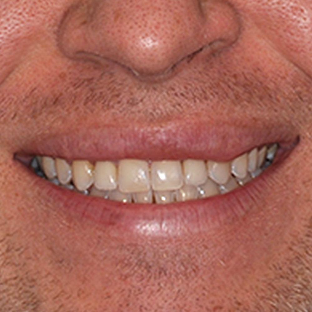 after Repairing Two Teeth and Improving the Whole Smile