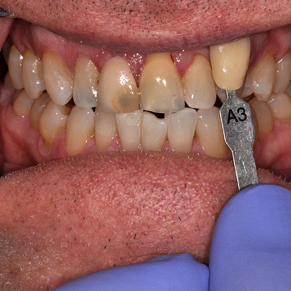 before Repairing Teeth That Are Stained with Receding Gums