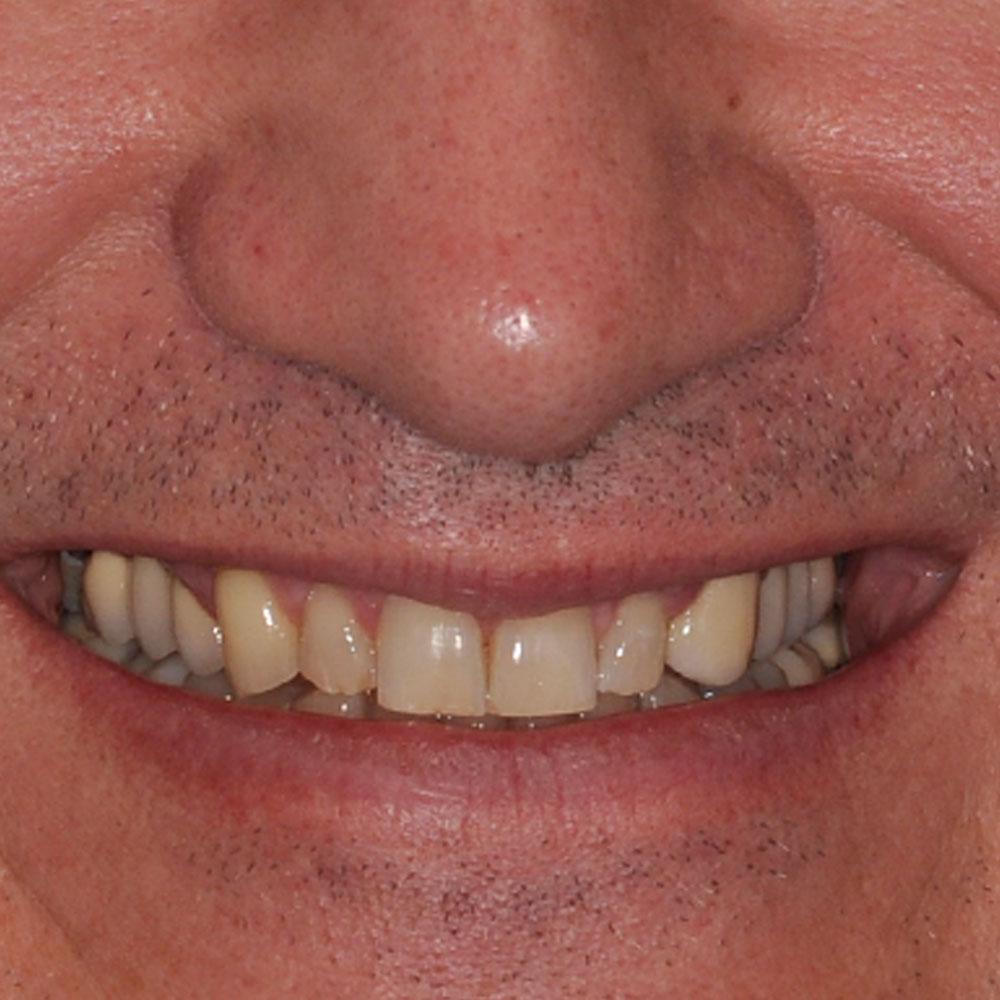 Before Using Implants to Repair a Smile