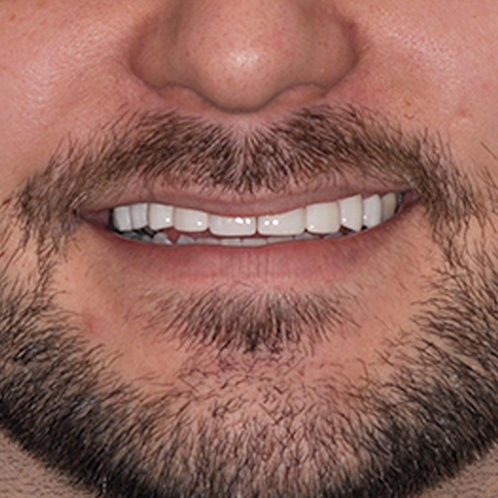 After Fixing Missing and Misaligned Teeth