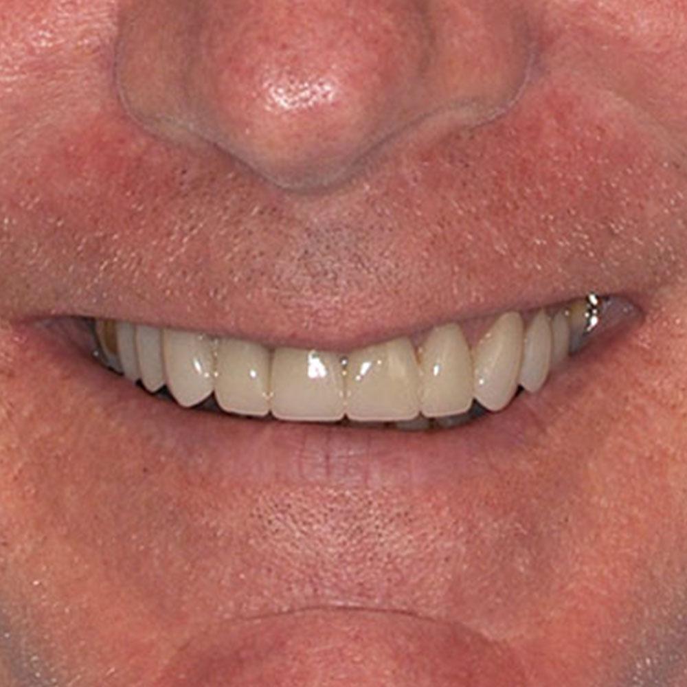 after Using Crowns to Repair Mismatched Dental Restorations