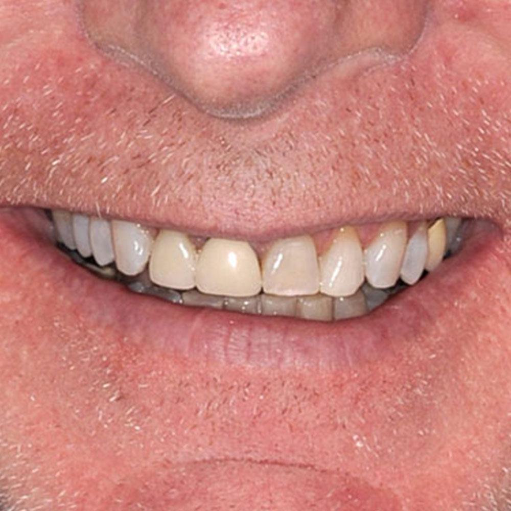 Using Crowns to Repair Mismatched Dental Restorations before