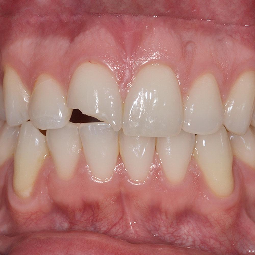 Before Repairing a Damaged Tooth with Excellent Results