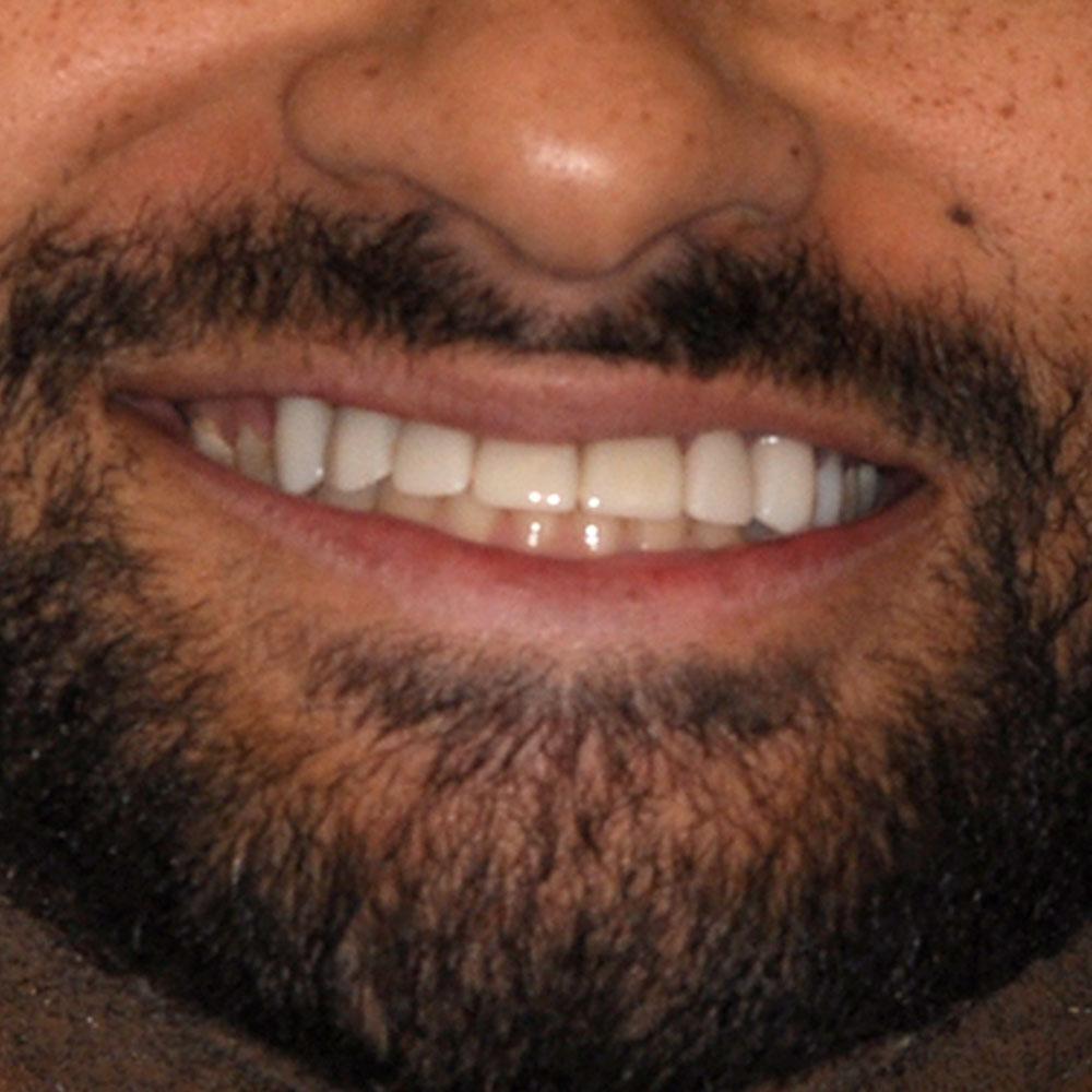 After Using Implants and Bridges to Restore a Smile