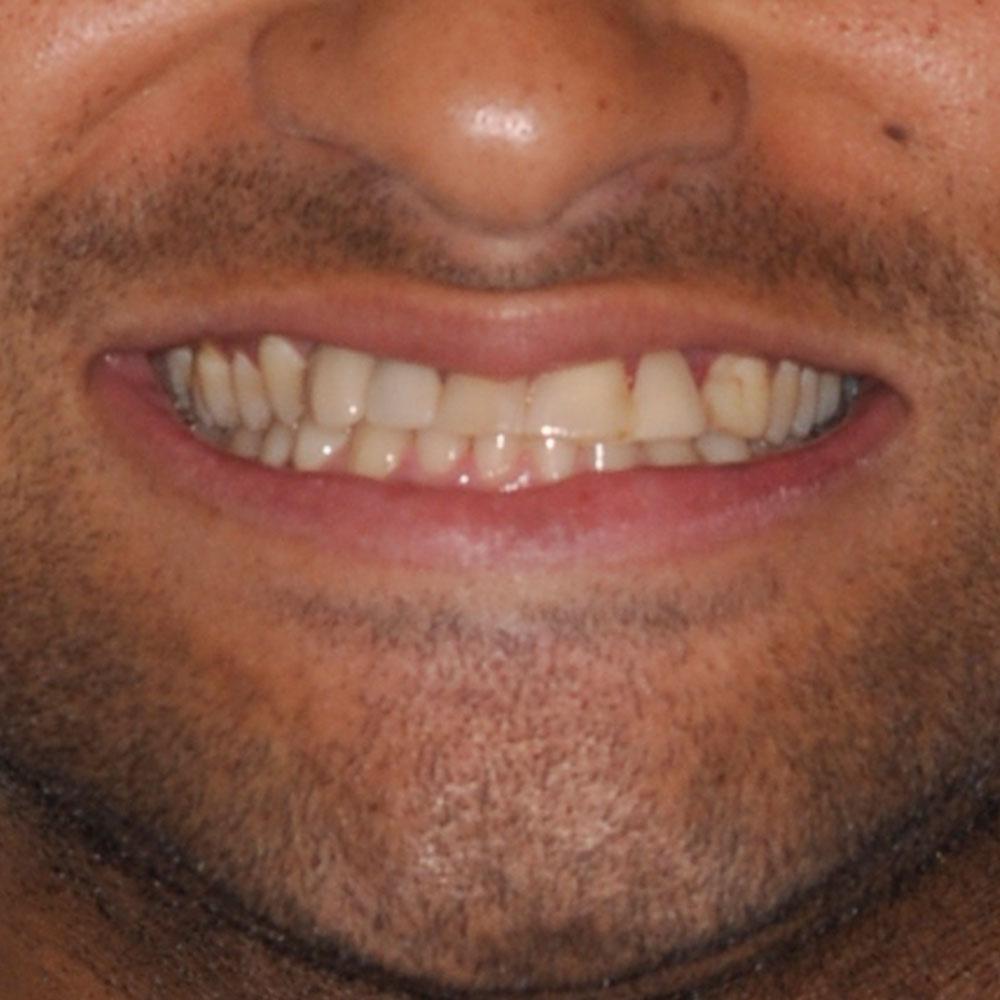 Before Using Implants and Bridges to Restore a Smile