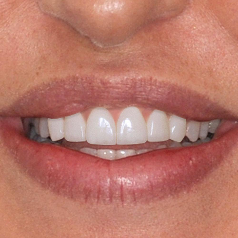 A simulation Using Veneers to Restore the Shape and Shine of this Smile