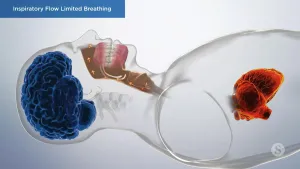 A video still - Inspiratory Flow Limited Breathing with an image showing how the airflow is working while a person is laying down
