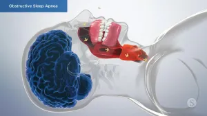 A video still - Obstructive Sleep Apnea with an image showing a person sleeping and the airflow traveling throughout their nose to lungs.