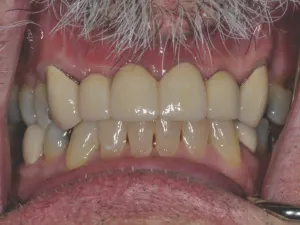 Case 302 Retracted After photo