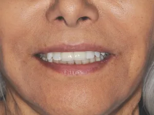 Case 303 closeup after photo