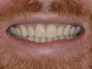 A photo of case 312 smiling after.