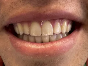case 501 full smile after photo