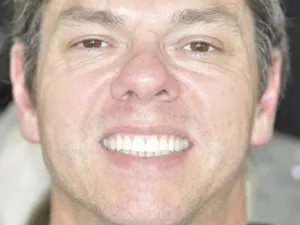 case 505 full face after photo