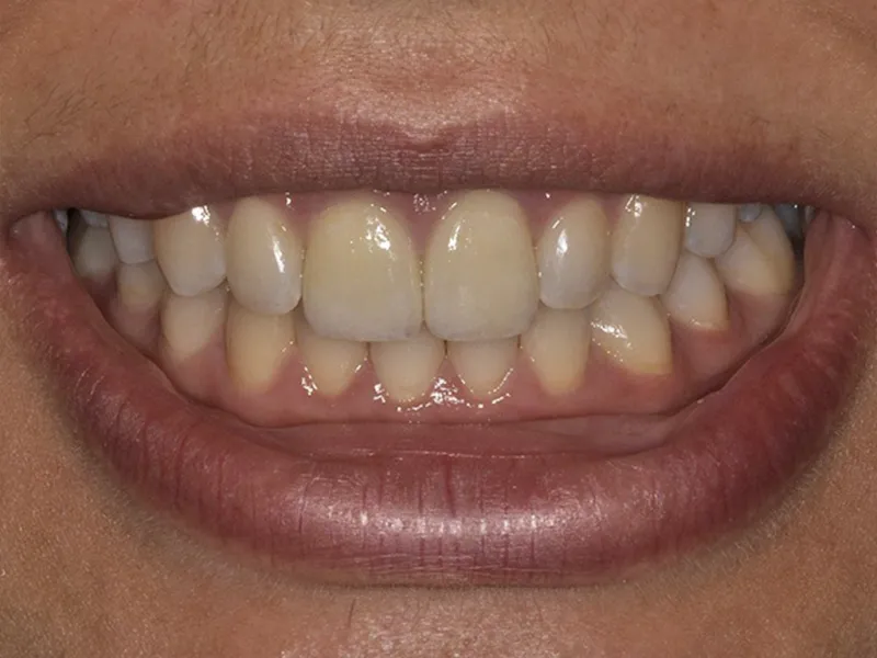 adding veneers to the front two teeth photo