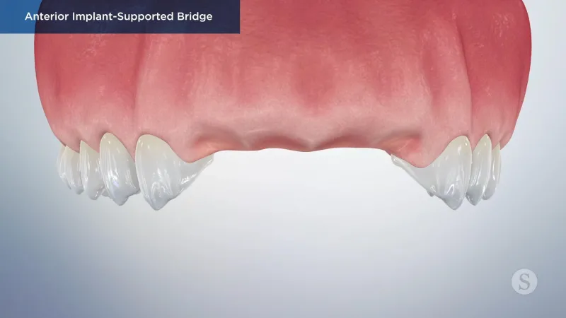 A video still - Anterior Implant-Supported Bridge with an image showing the top gum and teeth with the front teeth missing.