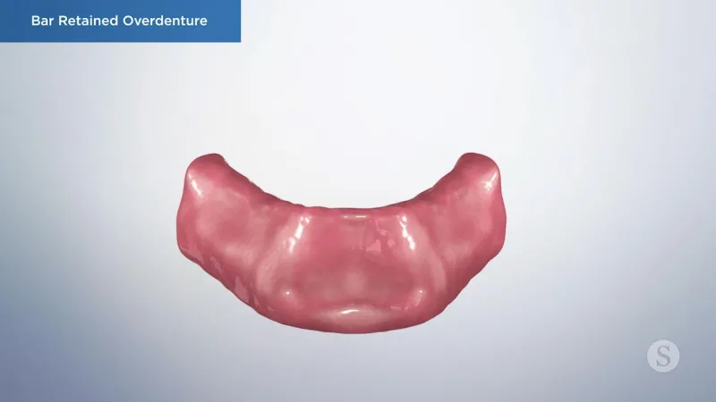 A video still - Bar Retained Overdenture with an image showing the bottom gum line.