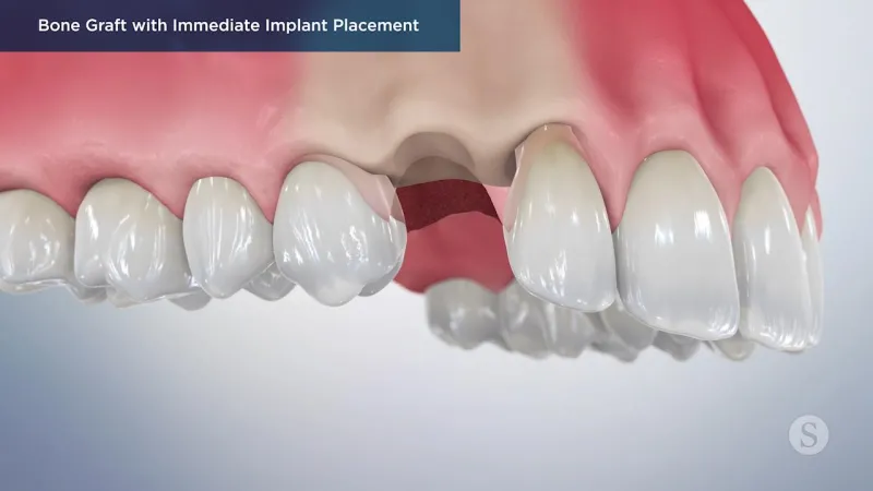 A video still - Bone Graft with Immediate Implant Placement with an image showing the top teeth with a missing tooth.