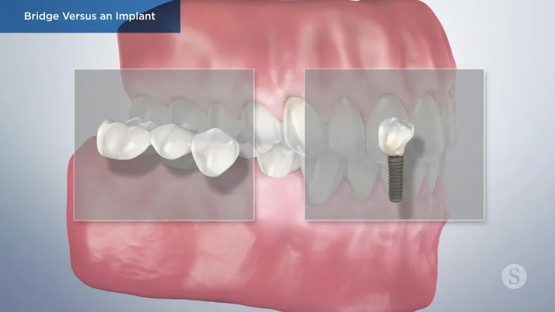 A video still - Bridge Versus an Implant with an image showing a mouth and two square boxes in front with the left box having an bridge 3d image and the right box having a 3d image of an implant.