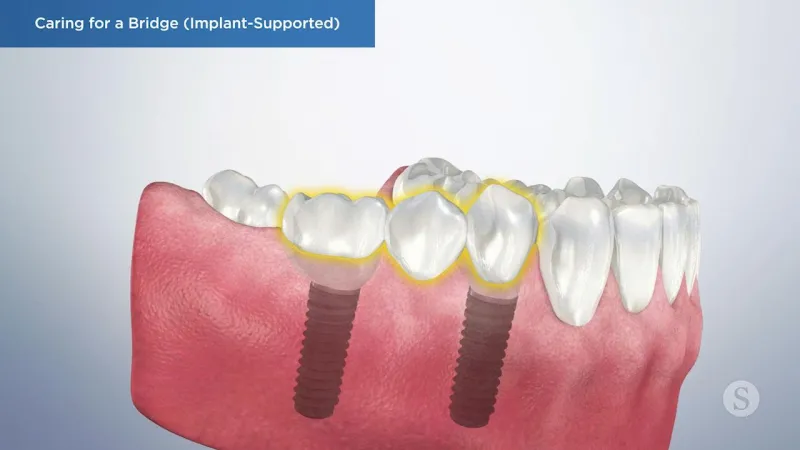 A video still - Caring for a Bridge (Implant-Support) with an image showing the bottom row of teeth with implants.