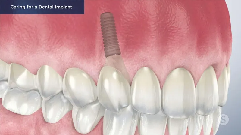 A video still - Caring for a Dental Implant with an image showing a smile with the implant.