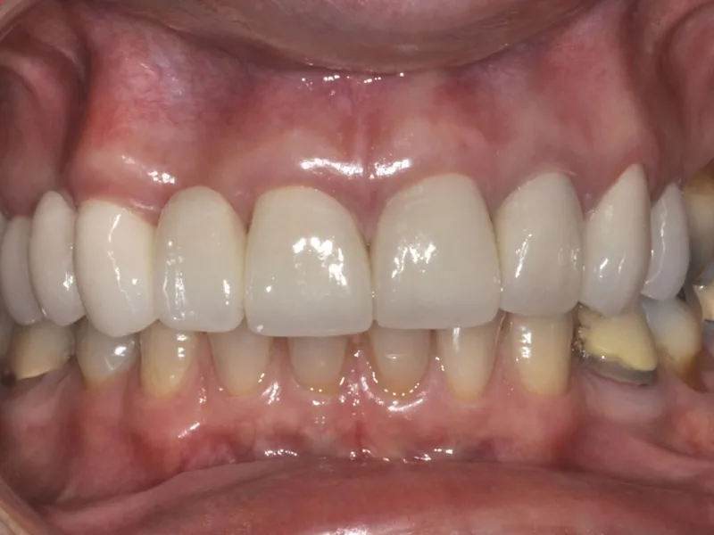 case 001 retracted after photo