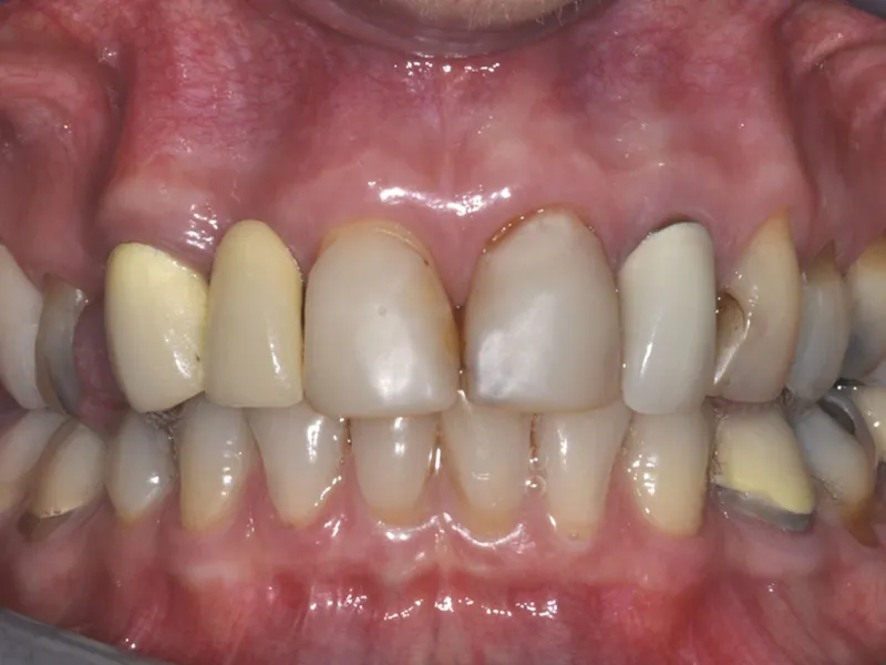 case 001 retracted before photo