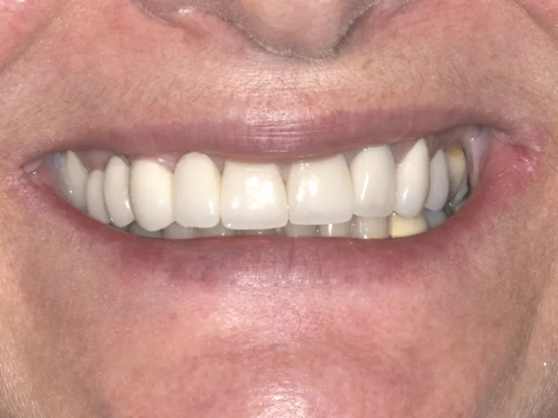 case 001 smile after photo
