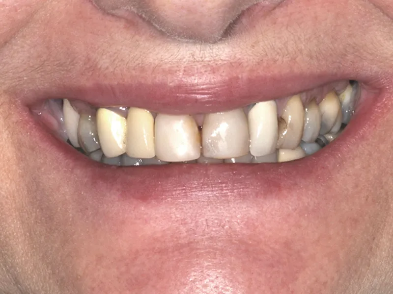case 001 smile before photo