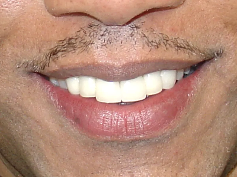 case 002 smile after photo