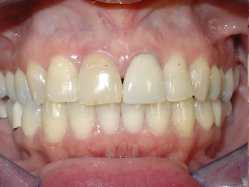 case 003 retracted after photo
