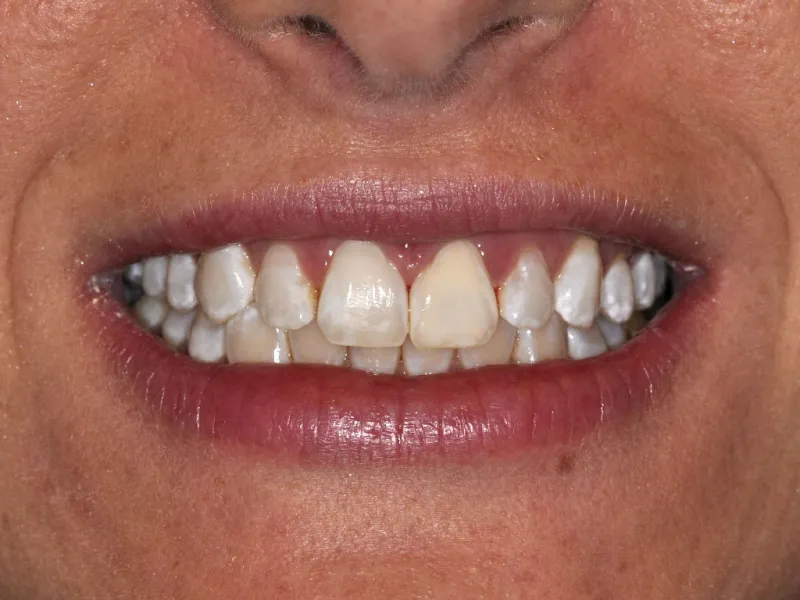 case 004 smile after photo