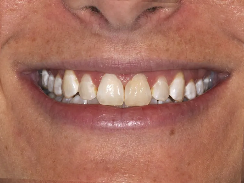 case 004 smile before photo