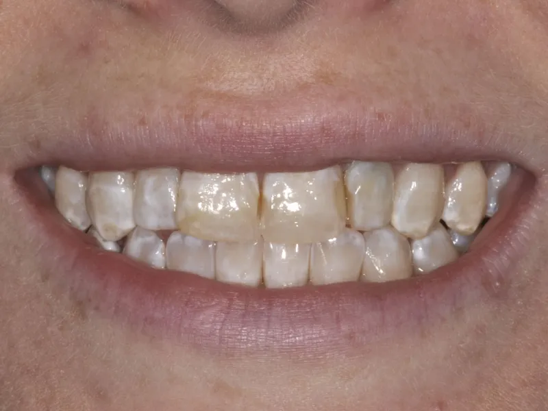 case 006 smile after photo