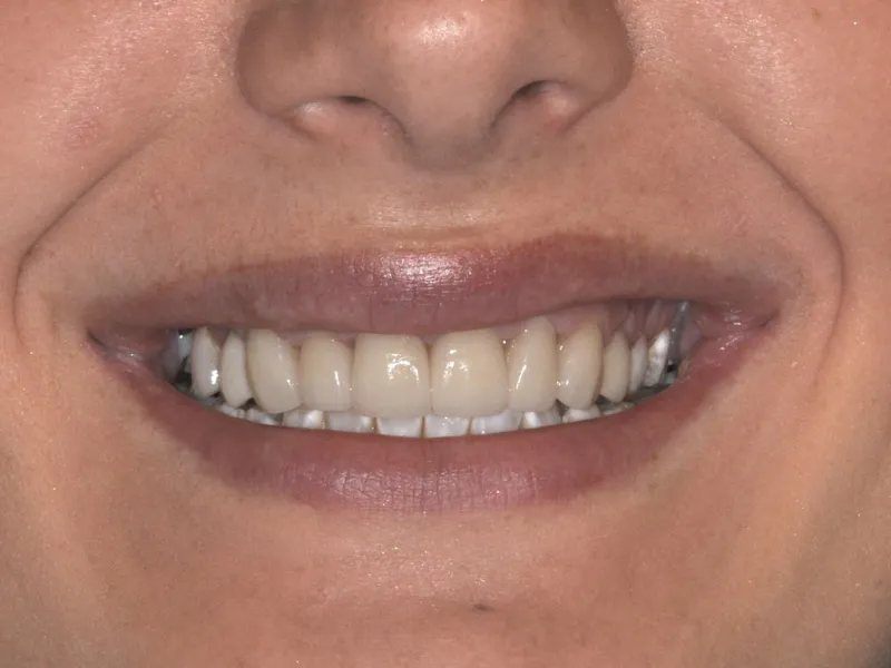 case 007 smile after photo