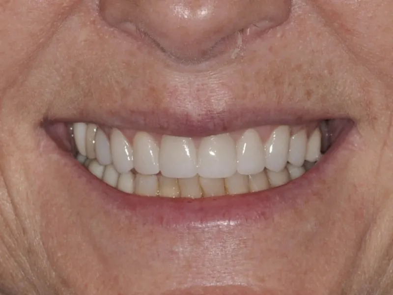 case 0102 smile after photo 