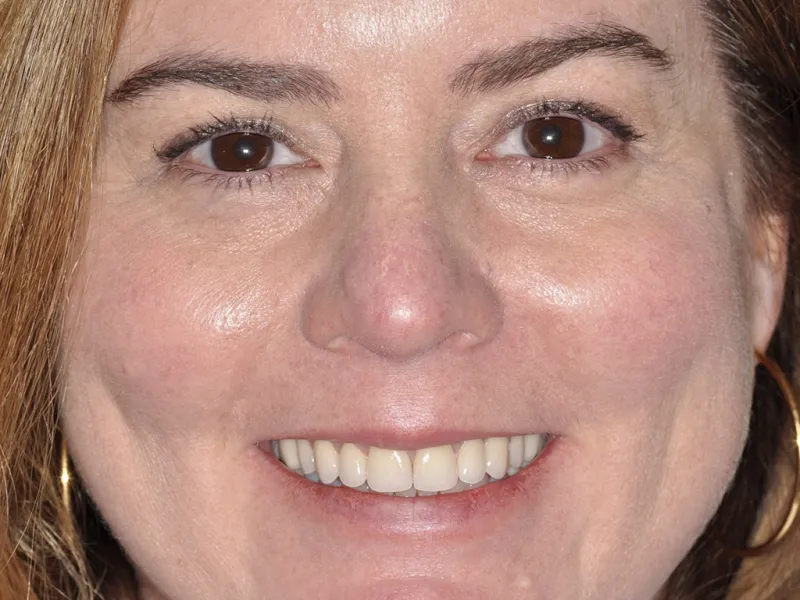 Case 0105 full face after photo