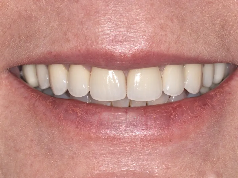 case 0105 smile after photo