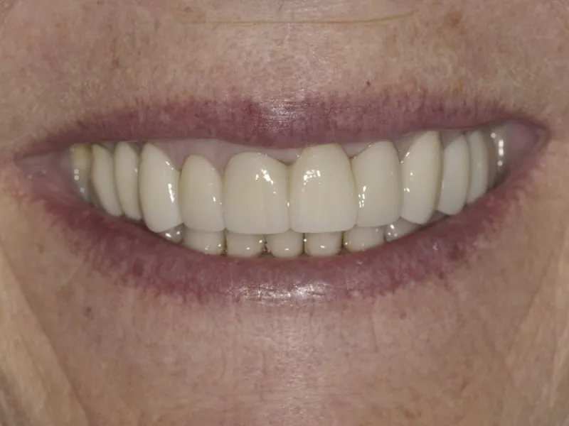 Case 0111 Smile After photo 