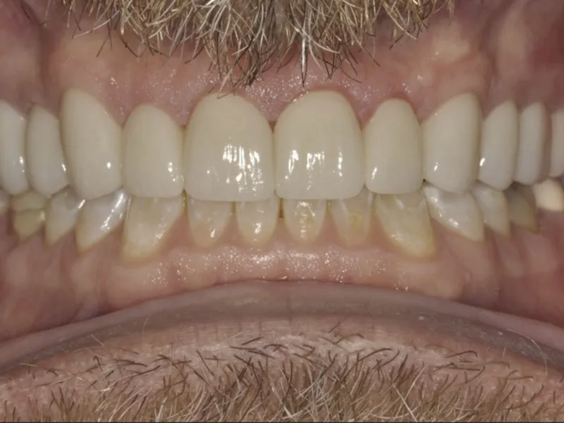 Case 0113 Retracted After